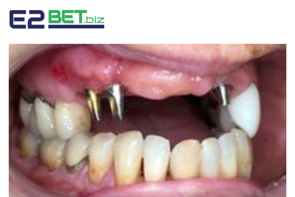 Nằm Mơ Thấy Gãy Răng Cửa Đánh Đề Con Gì? Giải Mã Chi Tiết Giấc Mơ Đầy Ẩn Ý